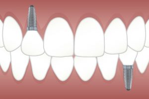 Exemple d'un implant dentaire 